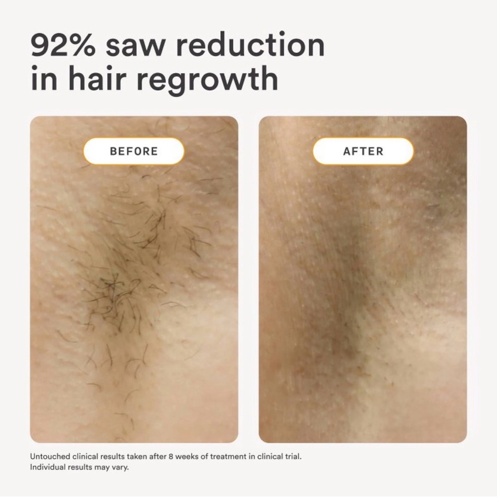 Nood 2.0 IPL Hair Removal Device - Picture 6 of 6